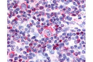 Anti-Nor-1 / NR4A3 antibody IHC of human Lymph Node, Hodgkins Lymphoma. (NR4A3 抗体  (Internal Region))