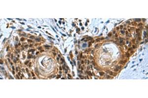 Immunohistochemistry of paraffin-embedded Human esophagus cancer tissue using ITGB1BP1 Polyclonal Antibody at dilution of 1:50(x200) (ITGB1BP1 抗体)