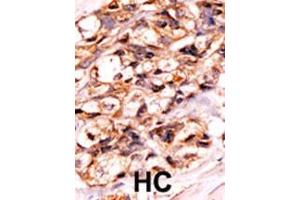 Formalin-fixed and paraffin-embedded human cancer tissue reacted with the primary antibody, which was peroxidase-conjugated to the secondary antibody, followed by AEC staining. (BAD 抗体  (pSer118))