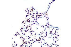 Immunohistochemistry of paraffin-embedded human thyroid cancer using hnRNP U Rabbit mAb (ABIN1679689, ABIN3018741, ABIN3018742 and ABIN7101656) at dilution of 1:100 (40x lens).