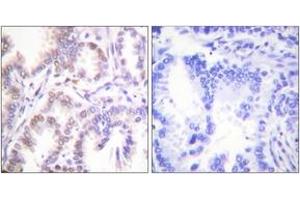 Immunohistochemistry analysis of paraffin-embedded human lung carcinoma tissue, using CDK7 Antibody. (CDK7 抗体  (AA 291-340))