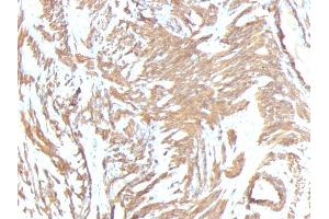 Formalin-fixed, paraffin-embedded human Leiomyosarcoma stained with Smooth Muscle Actin Monoclonal Antibody (1A4 + ACTA2/791). (Smooth Muscle Actin 抗体  (N-Term))