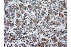 Immunohistochemical staining of paraffin-embedded Carcinoma of liver tissue using anti-CYP1A2 mouse monoclonal antibody. (CYP1A2 抗体)
