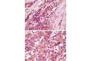 Immunohistochemical analysis of paraffin-embedded human stomach carcinoma (upper) and breast carcinoma (bottom) , showing cytoplasmic localization using FBLN5 monoclonal antibody, clone 3F10A5  with DAB staining. (Fibulin 5 抗体)