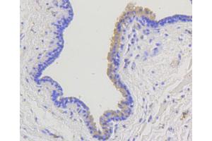 Immunohistochemistry of paraffin-embedded human mammary cancer using ARRB1 antibody (ABIN4903044) at dilution of 1:100 (40x lens). (beta Arrestin 1 抗体)