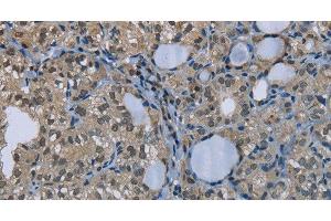 Immunohistochemistry of paraffin-embedded Human thyroid cancer using GYS1 Polyclonal Antibody at dilution of 1:50 (Glycogen Synthase 1 抗体)