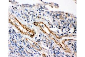 IHC-P: IKKb antibody testing of human lung cancer tissue (IKBKB 抗体  (AA 398-756))