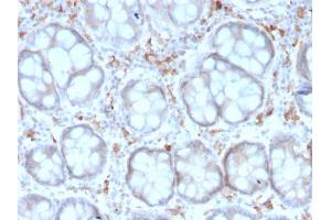 Formalin-fixed, paraffin-embedded human Colon Carcinoma stained with CD209 Mouse Monoclonal Antibody (rC209/1781). (Recombinant DC-SIGN/CD209 抗体)