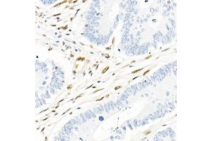 Immunohistochemistry of paraffin-embedded human colon carcinoma using QKI Rabbit mAb (ABIN7269699) at dilution of 1:1000 (40x lens). (QKI 抗体)