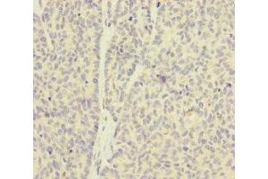 Immunohistochemistry of paraffin-embedded human ovarian cancer using ABIN7154941 at dilution of 1:100 (SKIV2L 抗体  (AA 1-140))