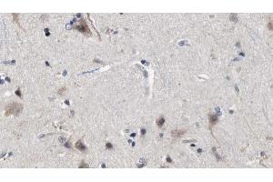 ABIN6272850 at 1/100 staining Human brain cancer tissue by IHC-P. (MFF 抗体  (Internal Region))