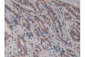 Detection of VNN1 in Human Stomach cancer Tissue using Polyclonal Antibody to Vanin 1 (VNN1) (VNN1 抗体  (AA 36-223))
