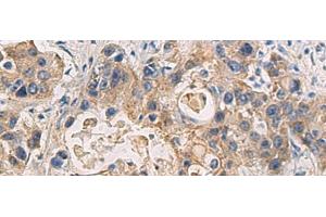 Immunohistochemistry of paraffin-embedded Human liver cancer tissue using DMRTA2 Polyclonal Antibody at dilution of 1:50(x200) (DMRTA2 抗体)