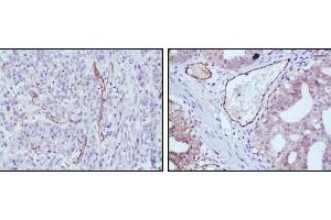 Immunohistochemical analysis of paraffin-embedded human stomach cancer (left) and ovary cancer (right) tissues using eNOS mouse mAb with DAB staining.