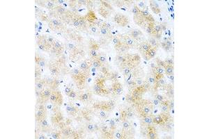 Immunohistochemistry of paraffin-embedded human liver cancer using DHODH antibody. (DHODH 抗体  (AA 116-395))