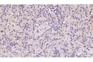 ABIN6273086 at 1/100 staining Human lymph cancer tissue by IHC-P. (VPS16 抗体  (Internal Region))