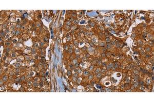 Immunohistochemistry of paraffin-embedded Human breast cancer tissue using PLEC Polyclonal Antibody at dilution 1:40 (PLEC 抗体)