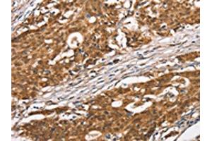 The image on the left is immunohistochemistry of paraffin-embedded Human gastric cancer tissue using ABIN7190465(DGAT1 Antibody) at dilution 1/40, on the right is treated with synthetic peptide. (DGAT1 抗体)