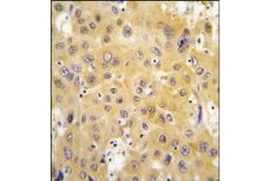 Formalin-fixed and paraffin-embedded human hepatocarcinoma tissue reacted with ECGF1 antibody (Center), which was peroxidase-conjugated to the secondary antibody, followed by DAB staining. (Thymidine Phosphorylase 抗体  (Middle Region))