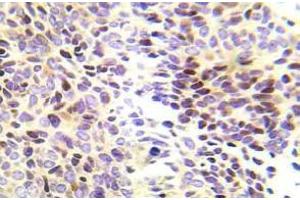 Immunohistochemistry (IHC) analyzes of CHK1 pAb in paraffin-embedded human lung adenocarcinoma tissue. (CHEK1 抗体)