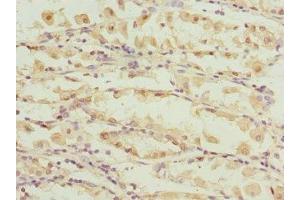 Immunohistochemistry of paraffin-embedded human gastric cancer using ABIN7146516 at dilution of 1:100 (Calpain S1 抗体  (AA 69-268))