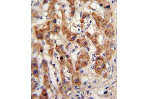 Formalin-fixed and paraffin-embedded human hepatocarcinoma with NAT2 Antibody (C-term), which was peroxidase-conjugated to the secondary antibody, followed by DAB staining. (NAT2 抗体  (C-Term))