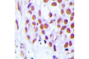 Immunohistochemical analysis of FOG2 staining in human breast cancer formalin fixed paraffin embedded tissue section. (ZFPM2 抗体)