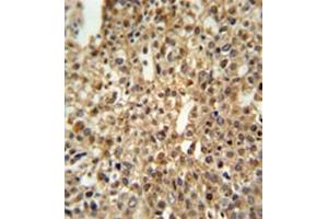 Formalin fixed and paraffin embedded human cervix carcinoma reacted with DENND1A Antibody (C-term) followed by peroxidase conjugation of the secondary antibody and DAB staining.