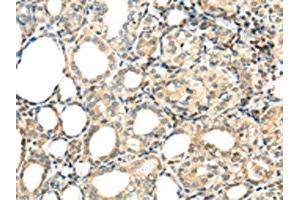 The image on the left is immunohistochemistry of paraffin-embedded Human thyroid cancer tissue using ABIN7192947(TSPYL6 Antibody) at dilution 1/20, on the right is treated with synthetic peptide. (TSPY-Like 6 抗体)
