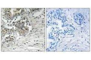 Immunohistochemistry analysis of paraffin-embedded human prostate carcinoma tissue using Claudin 7 (Ab-210) antibody. (Claudin 7 抗体  (Tyr210))