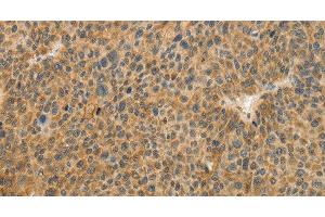 Immunohistochemistry of paraffin-embedded Human liver cancer tissue using TFPI2 Polyclonal Antibody at dilution 1:30 (TFPI2 抗体)