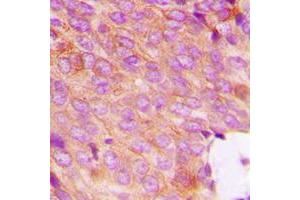 Immunohistochemical analysis of DOK2 (pY299) staining in human breast cancer formalin fixed paraffin embedded tissue section. (DOK2 抗体  (pTyr299))