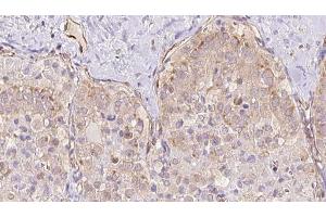 ABIN6273328 at 1/100 staining Human thyroid cancer tissue by IHC-P. (TBC1D23 抗体  (Internal Region))