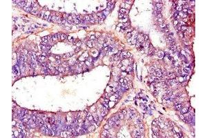 Immunohistochemistry of paraffin-embedded human endometrial cancer using ABIN7144954 at dilution of 1:100 (PFKM 抗体  (AA 166-334))