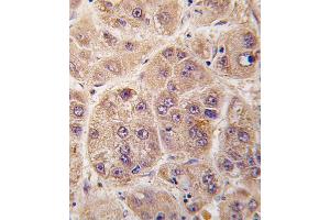 Formalin-fixed and paraffin-embedded human hepatocarcinoma tissue reacted with PIM3 antibody (C-term) (ABIN391253 and ABIN2841313) , which was peroxidase-conjugated to the secondary antibody, followed by DAB staining. (PIM3 抗体  (C-Term))
