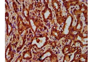 IHC image of ABIN7151907 diluted at 1:300 and staining in paraffin-embedded human liver cancer performed on a Leica BondTM system. (EGFL7 抗体  (AA 73-198))