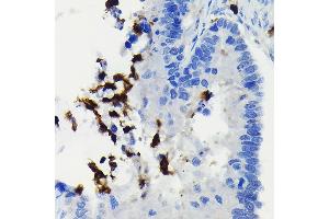 Immunohistochemistry of paraffin-embedded human colon carcinoma using FADD Rabbit mAb (ABIN7267135) at dilution of 1:100 (40x lens). (FADD 抗体)