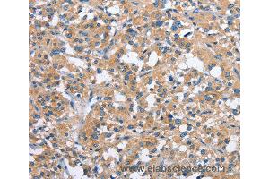 Immunohistochemistry of Human thyroid cancer using PAK2 Polyclonal Antibody at dilution of 1:40 (PAK2 抗体)