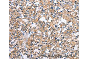 Immunohistochemistry of Human thyroid cancer using PAK2 Polyclonal Antibody at dilution of 1:40