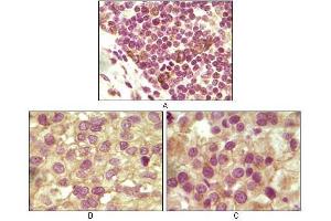 Immunohistochemical analysis of paraffin-embedded human lymphoid (A), ovary tumor (B) and testicle tumor (C) tissues using INHA antibody with DAB staining. (Inhibin alpha 抗体)