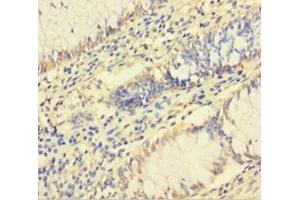 Immunohistochemistry of paraffin-embedded human colon cancer using ABIN7142784 at dilution of 1:100 (RPL26L1 抗体  (AA 1-145))