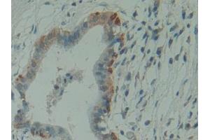 Detection of HMBS in Human Pancreas cancer Tissue using Polyclonal Antibody to Hydroxymethylbilane Synthase (HMBS) (HMBS 抗体  (AA 85-337))