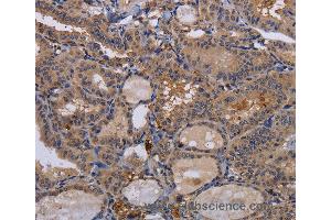 Immunohistochemistry of Human thyroid cancer using FADS1 Polyclonal Antibody at dilution of 1:60 (FADS1 抗体)