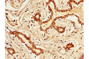 IHC image of ABIN7157190 diluted at 1:300 and staining in paraffin-embedded human breast cancer performed on a Leica BondTM system. (Kallikrein 1 抗体  (AA 25-262))