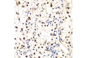 Immunohistochemistry of paraffin-embedded human kidney cancer using NFKBIB antibody (ABIN5973399) at dilution of 1/200 (40x lens). (NFKBIB 抗体)