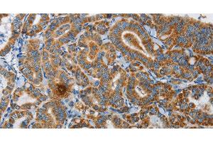 Immunohistochemistry of paraffin-embedded Human thyroid cancer using UPF1 Polyclonal Antibody at dilution of 1:35 (RENT1/UPF1 抗体)