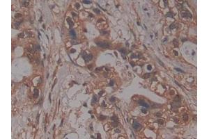 DAB staining on IHC-P; Samples: Human Pancreatic cancer Tissue (PRCP 抗体  (AA 108-376))