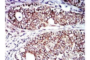 Immunohistochemical analysis of paraffin-embedded cervical cancer tissues using CD129 mouse mAb with DAB staining. (IL9 Receptor 抗体  (AA 41-270))