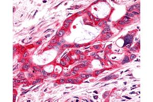 Anti-FZD9 / Frizzled 9 antibody IHC of human Pancreas, Carcinoma. (FZD9 抗体  (N-Term))