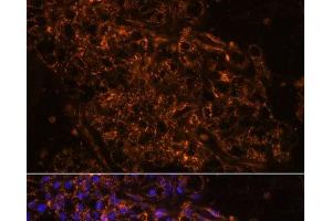 Immunofluorescence analysis of Human kidney cancer using SCNN1G Polyclonal Antibody at dilution of 1:100. (SCNN1G 抗体)